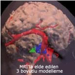 MRİ ile elde edilen 3 boyutlu modelleme