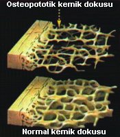 Osteoporotik ve normal kemik dokusu